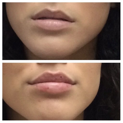 Lip Filler Before/After TX