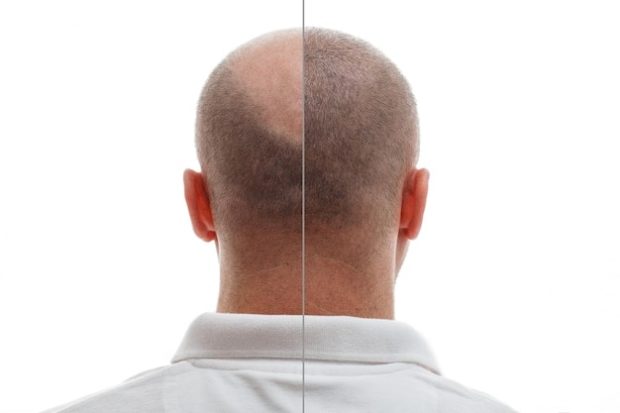 Hair Restoration men before and after