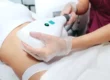 A woman receiving CoolSculpting in San Antonio, TX