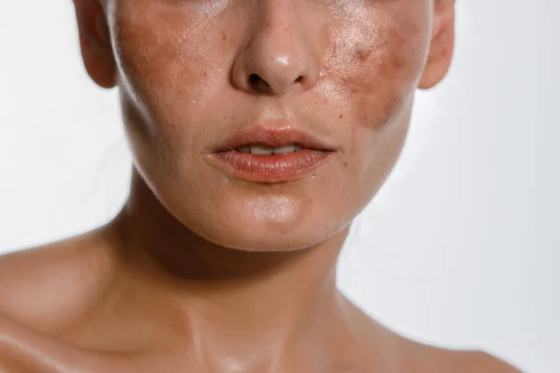 Close-up of a woman's face showing visible melasma, dark brown patches, and hyperpigmentation on the cheeks and nose.