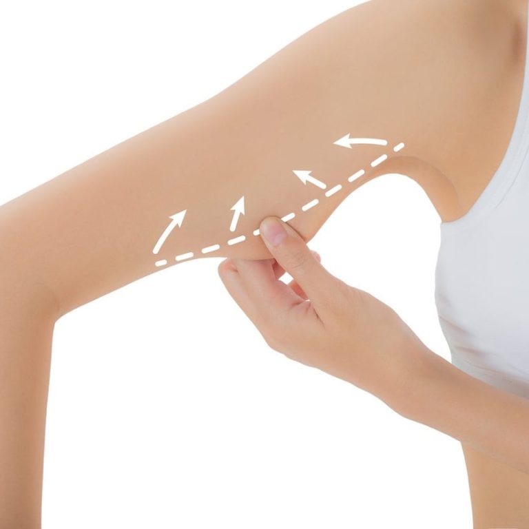 Evolve Tite Procedure for Arms by Flawless Laser