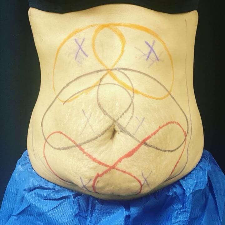 CoolSculpting