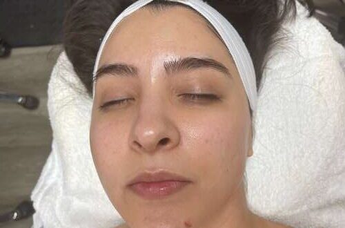 Dermaplaning San Antonio, TX